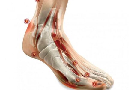 Stopa Mortona - Leczenie w Warszawie